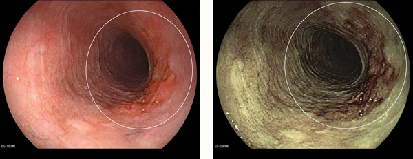 早期食道がん(粘膜下層浸潤)