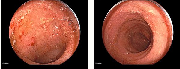 潰瘍性大腸炎