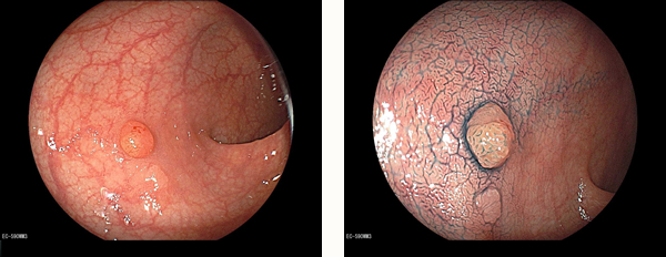 大腸ポリープ