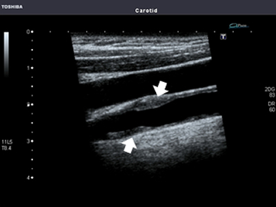 総頸動脈のプラーク